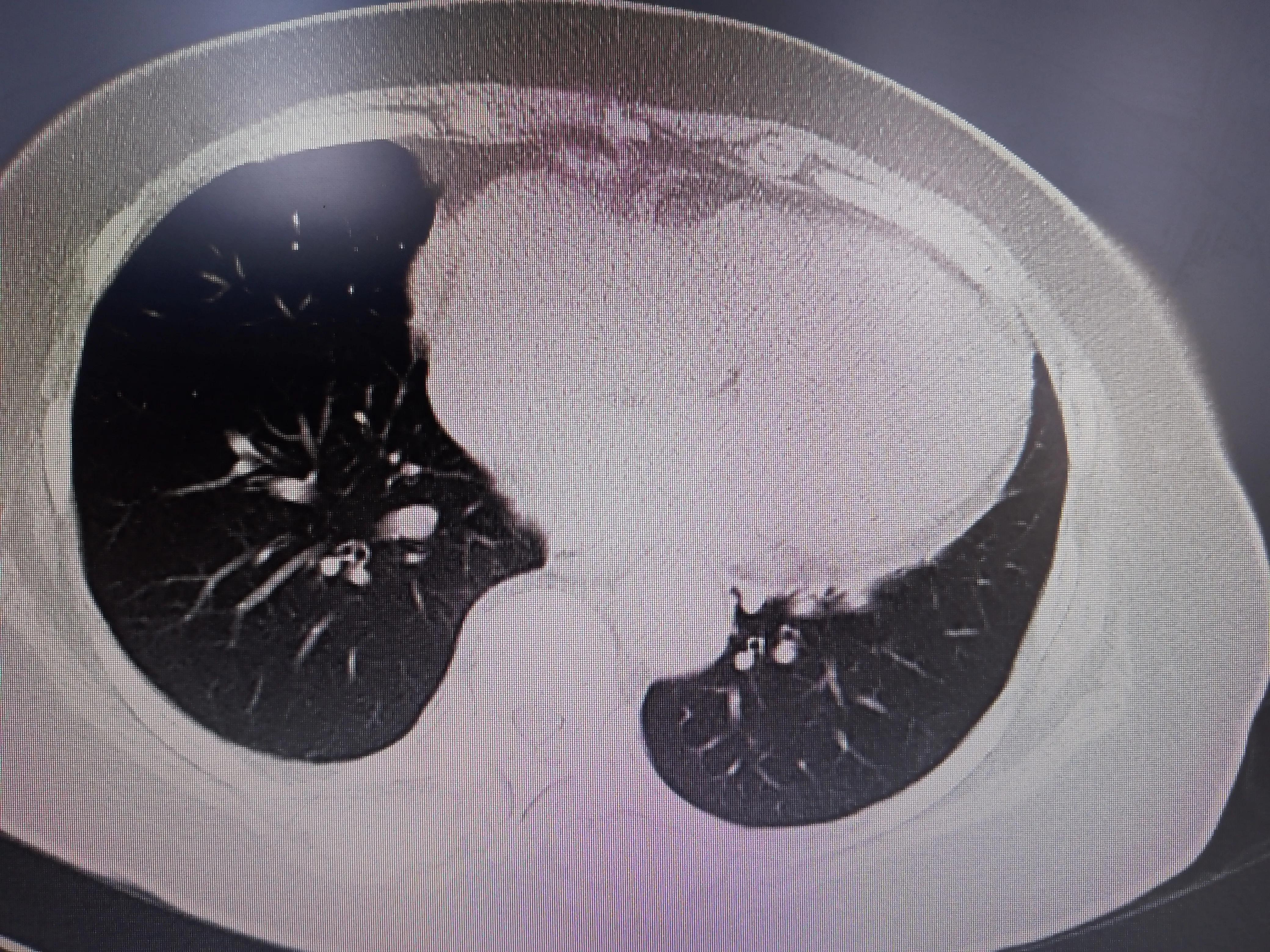 心血管病人吃伟哥,心血管病人可以用伟哥吗