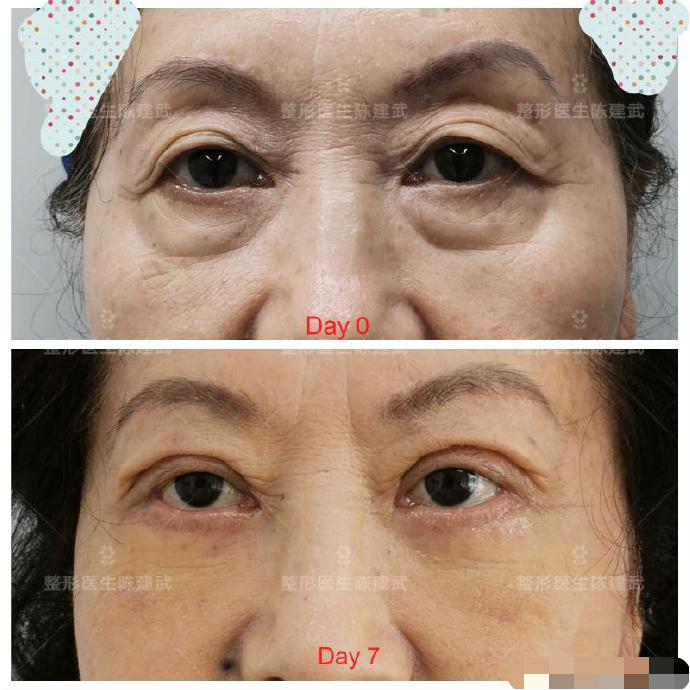 去眼袋泪沟医美方法,想了解一下去眼袋的最佳方法