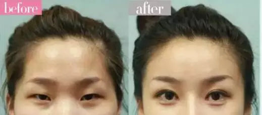 双眼皮不要盲目跟风,别割双眼皮