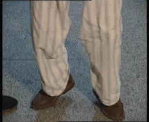 帕金森服药后加重病症,帕金森患者吃药后有什么症状