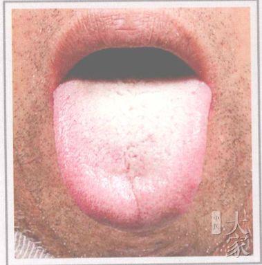 中医解读：新型肺炎患者中的元凶“湿浊”从何而来？