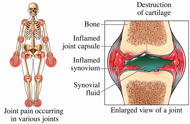 糖尿病跟骨关节有关系吗,糖尿病和膝盖疼有联系吗