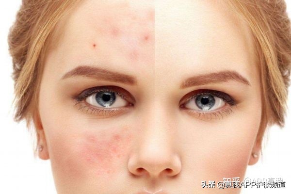 刷酸后脸上长了好多小痘痘正常吗,刷酸后脸过敏长痘怎么办