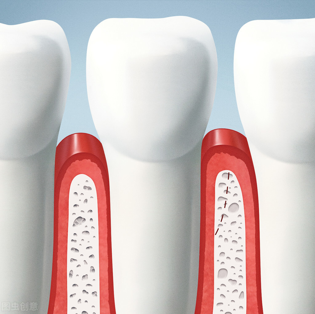 种完牙有黑三角怎么办,种植牙黑三角怎么处理