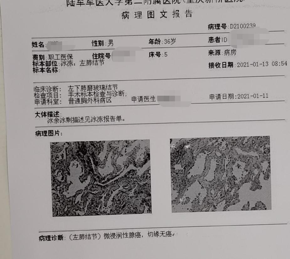 磨玻璃结节微浸润腺癌,纯磨玻璃结节微浸润腺癌治愈率