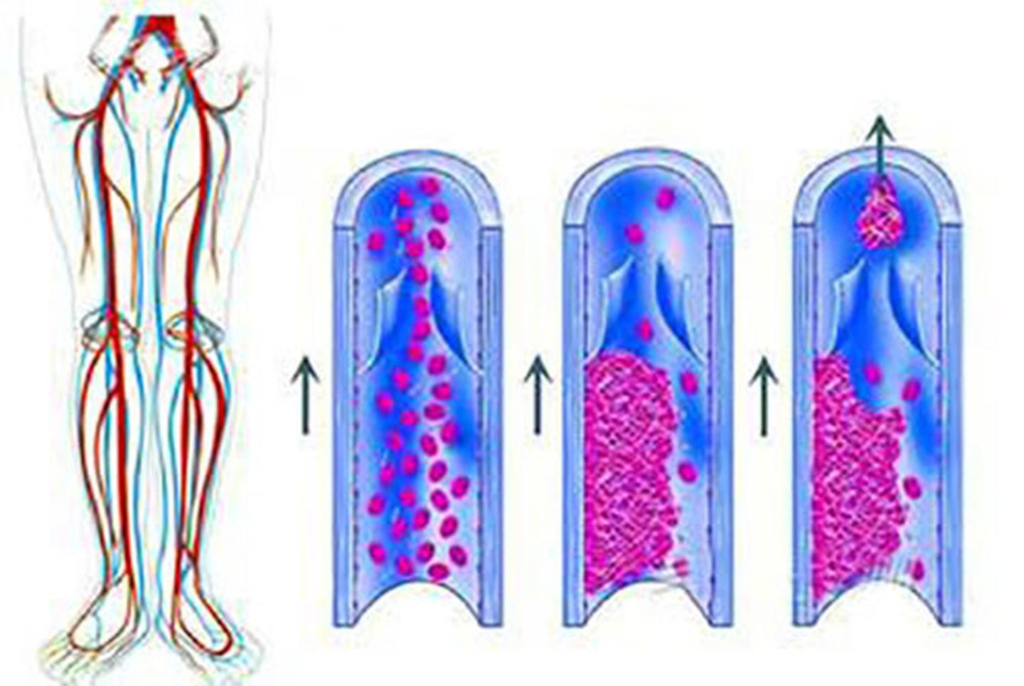 摔个跤竟收到病危通知书？泰宝医疗提醒你：警惕下肢深静脉血栓