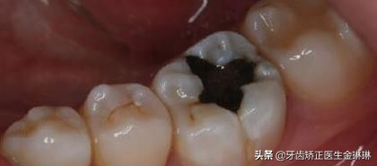 补牙材料银汞吃下去了要紧吗,补牙的银汞材料边缘掉了一点