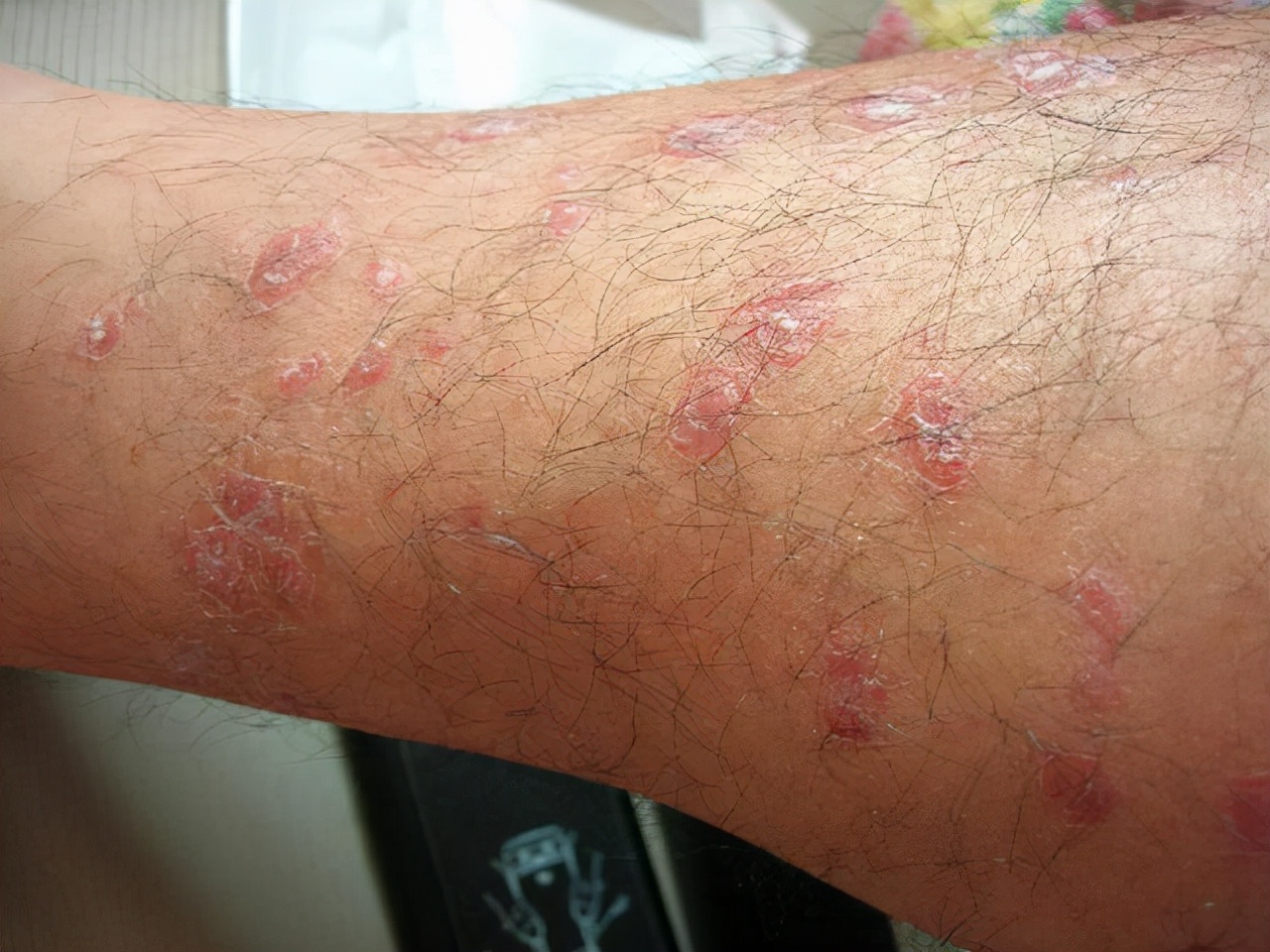 2块钱一袋的甲硝唑有副作用吗,平价药甲硝唑用处真不少