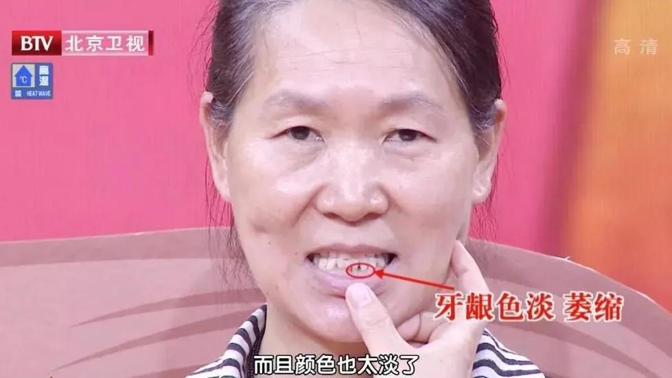 吃饭老塞牙缝怎么治疗,吃饭总塞牙你知道问题出在哪里吗