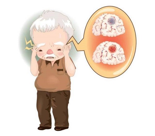 脑中风前期征兆有哪些,脑中风的十个高危因素