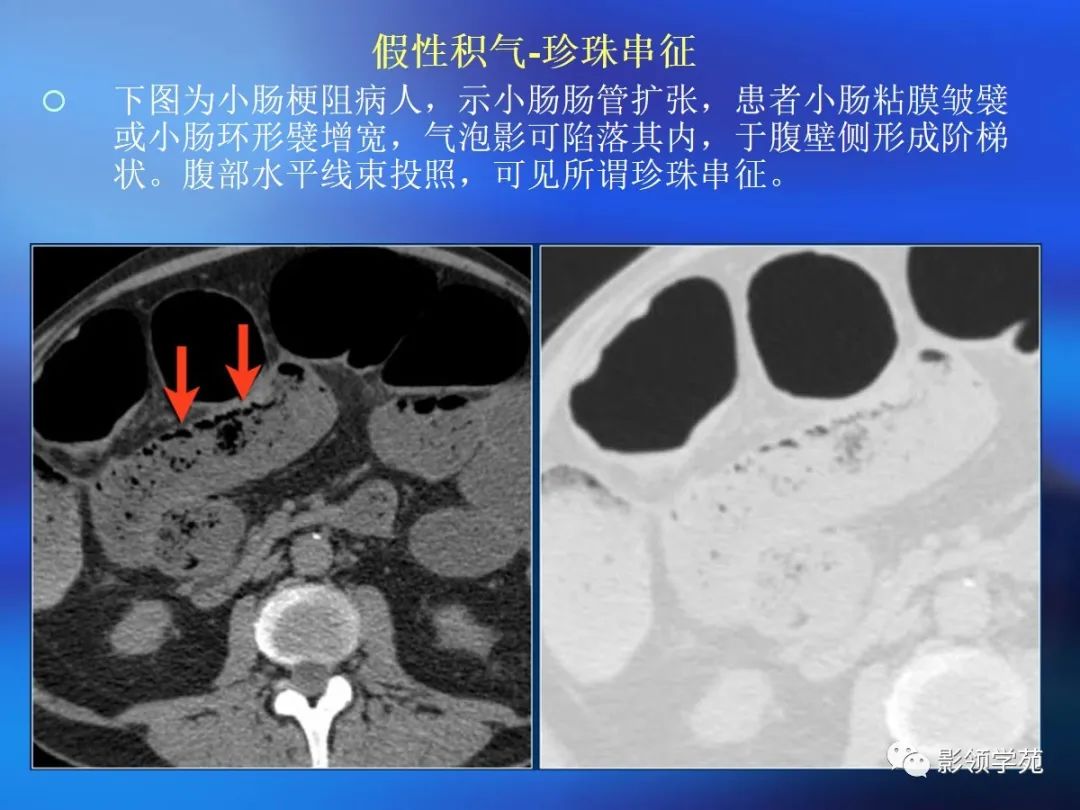 肠道内壁增厚,肠道扩张ct表现