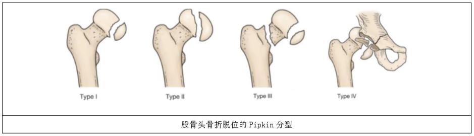 pipkin骨折,pipkin的视频