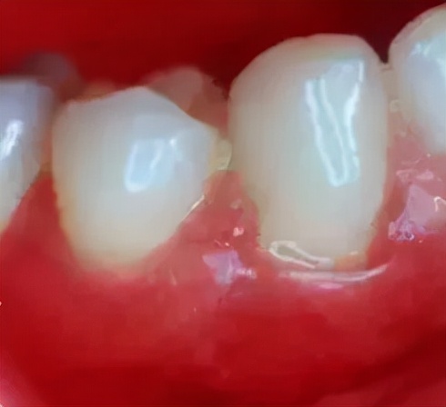 牙根痒痒像塞东西似的怎么回事,牙根痒痒的老想咬东西怎么回事