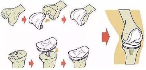 名医专访丨上海六院骨科刘万军:膝关节置换常见问题