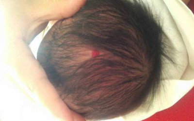 肝血管瘤多发严重吗需要注意什么,婴儿激光祛血管瘤注意事项