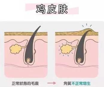 鸡皮肤怎么消除最彻底方法,额头鸡皮肤怎么消除最有效