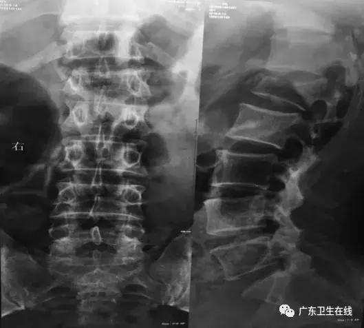 从高处掉下来腰部粉碎性骨折,高处跌落脊椎骨折需要手术吗
