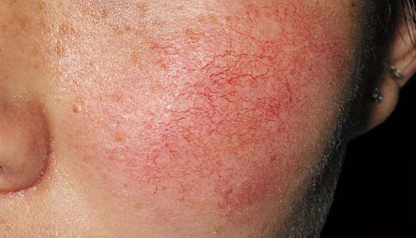 脸部红血丝怎么去除有效,脸部红血丝该怎样祛除呢