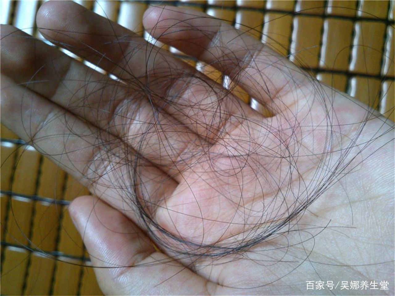 年轻人脱发有白头发是什么原因,年轻人头顶脱发是什么原因造成的