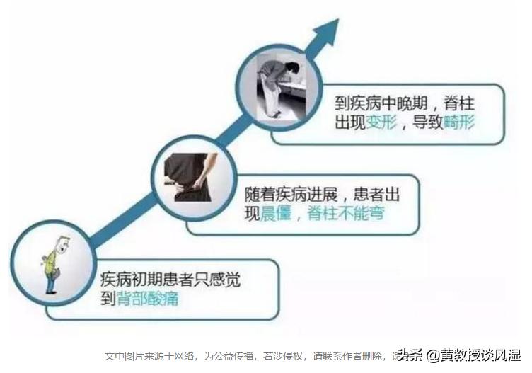 高中生熬夜学习,早上起床腰痛不已元凶:得了强直性脊柱炎