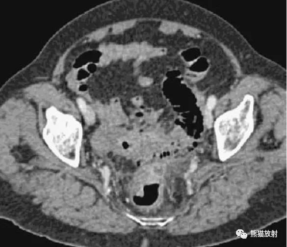 腹部影像图片大全,乙状直肠疼痛位置图片