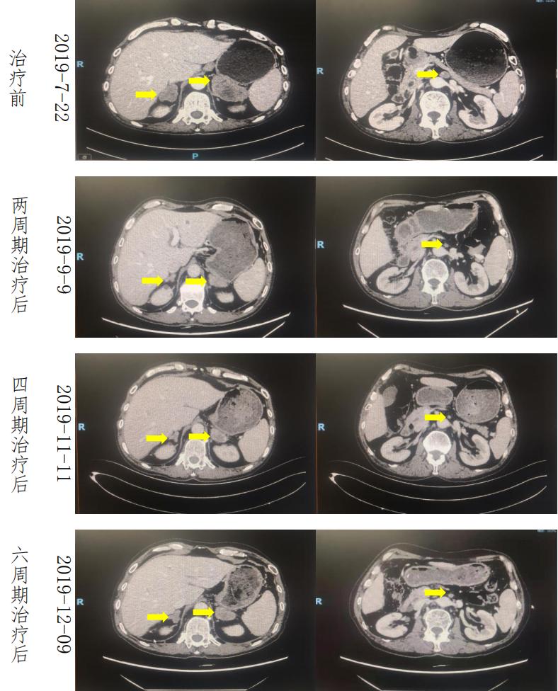 六旬男子小肠癌晚期,经化疗联合免疫治疗后疾病获得长期缓解。免疫治疗或将成为肠癌重要的治疗手段