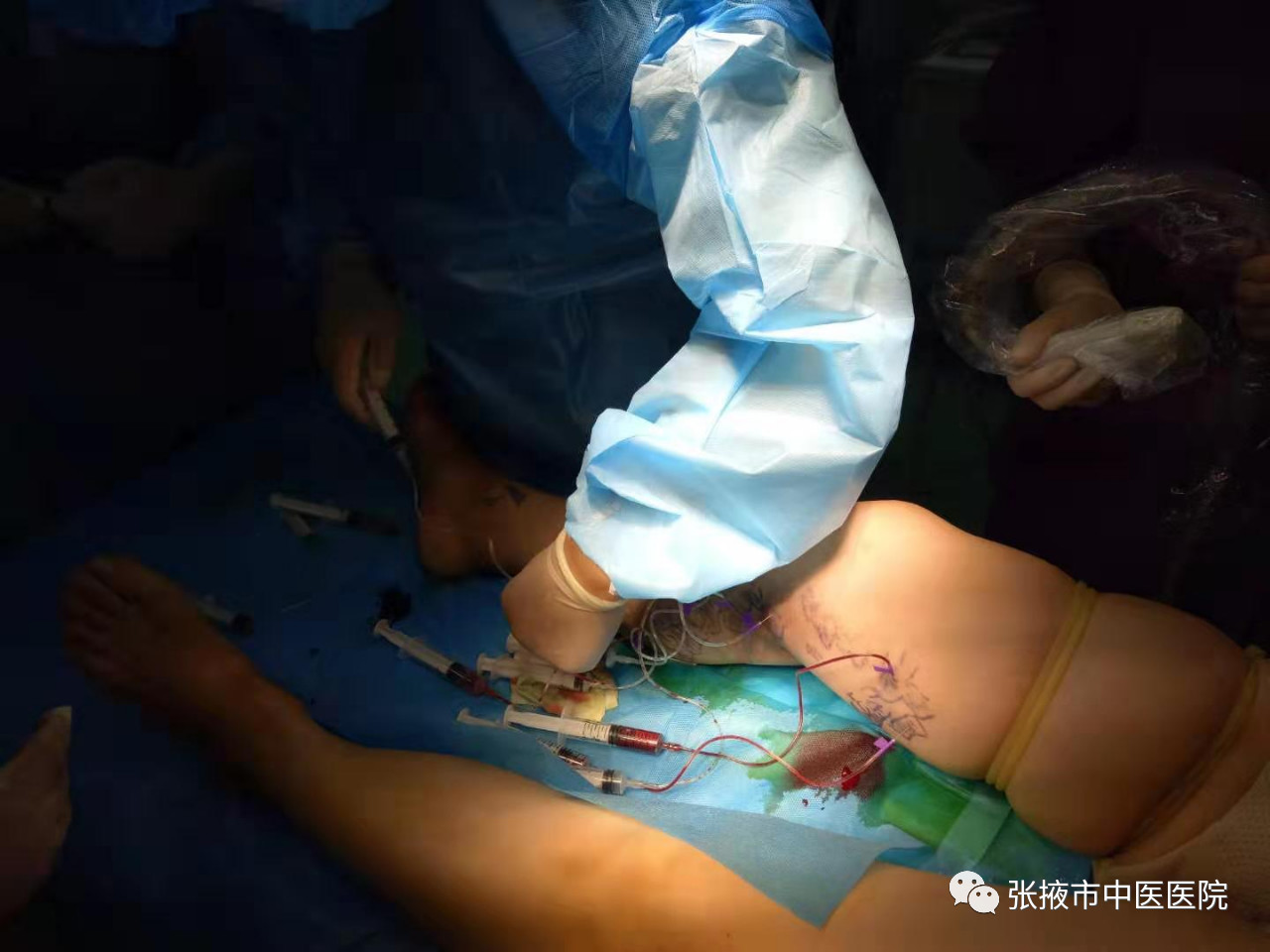 聚桂醇治疗静脉曲张护理操作,张掖市医院下肢静脉曲张微创手术