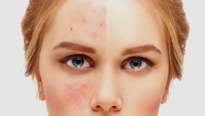 痘痘肌生活中有哪些需要注意的,痘痘肌护肤注意事项图片卡通