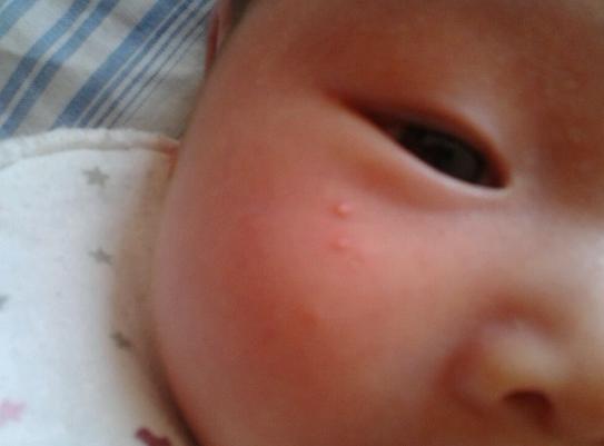新生儿额头湿疹怎么消除又快又好,额头上湿疹黑斑要多长时间能消除