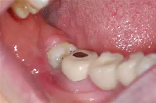 智齿冠周炎张口受限伴吞咽疼痛,智齿冠周炎一般疼痛多久