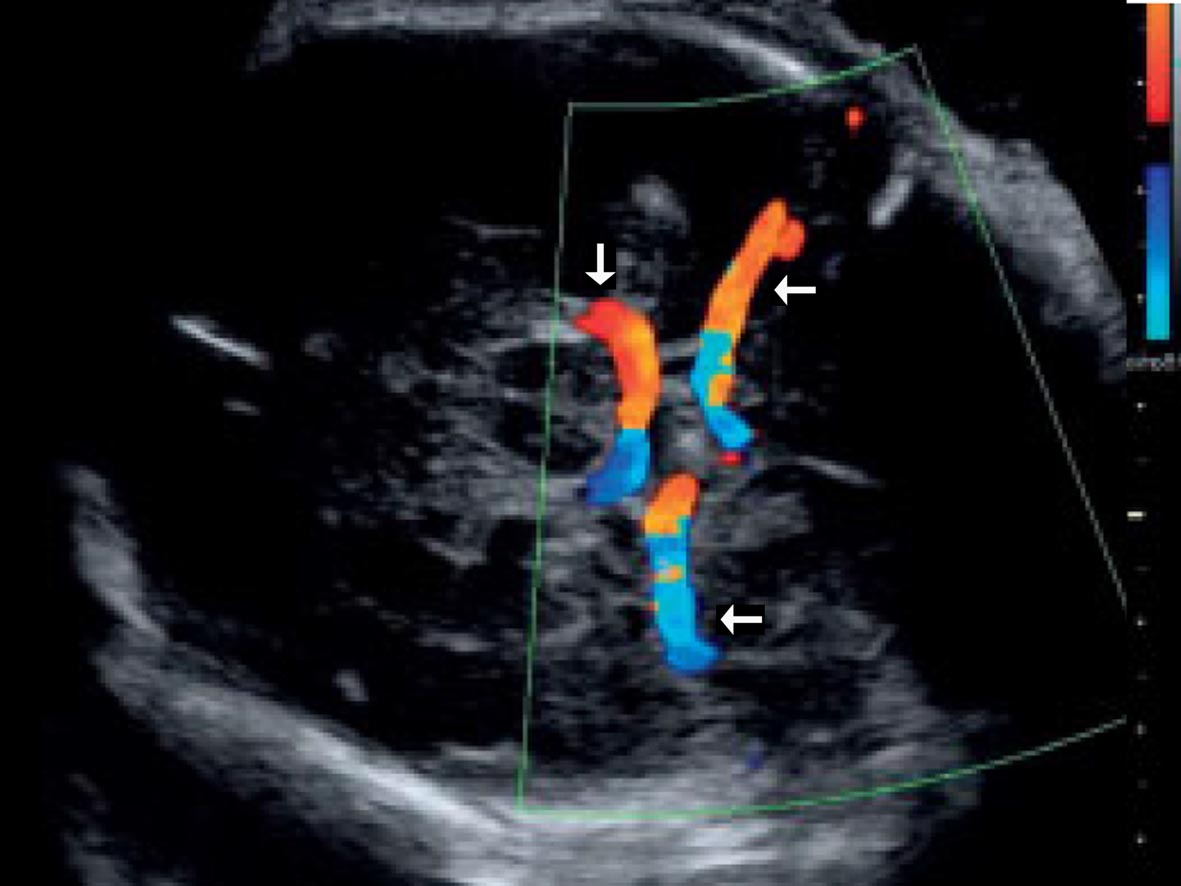 做彩超是不是能清楚看见胎儿,做彩超胎儿仰面平躺