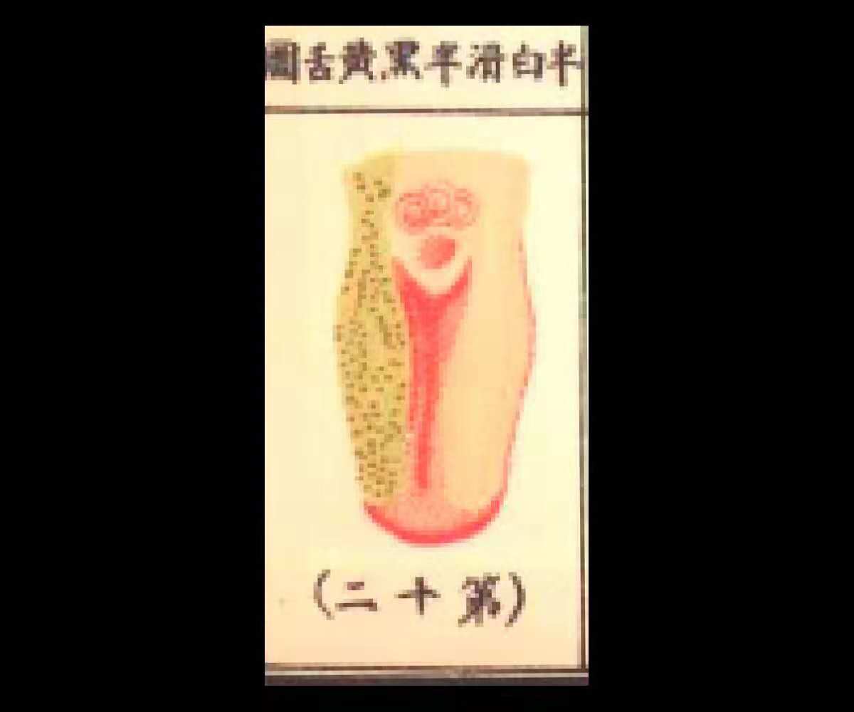 脾胃湿寒心热的舌象,白苔舌根黄