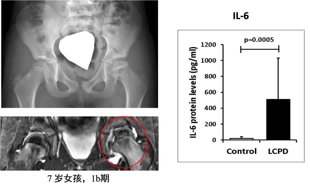 髋关节滑膜炎和髋关节滑囊炎区别,髋关节滑膜炎可用prp治疗吗