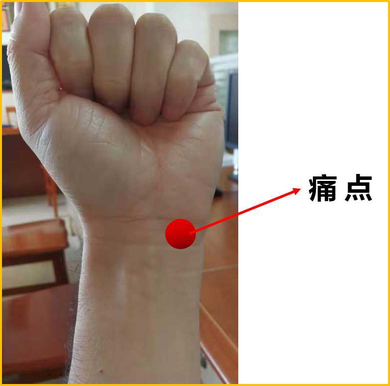 手腕、胳膊疼痛难忍,久治不愈如何破?关节骨科博士助你解烦忧