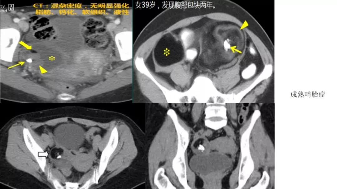 卵巢原发肿瘤的分析思路