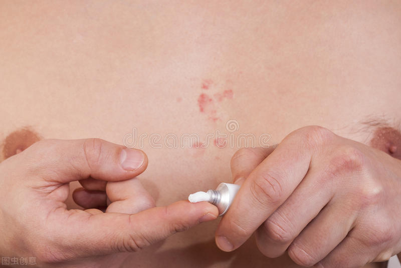 湿疹高发期来了如何正确防治,湿疹最新的治疗方法