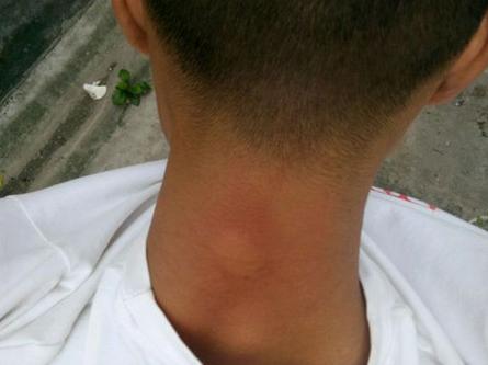 被马蜂蜇了有什么方法缓解,被马蜂蜇了的最快速处理办法