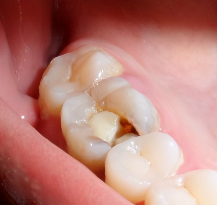 根管治疗做冠的牙齿会裂开吗,根管治疗后牙齿裂了还能做外冠吗