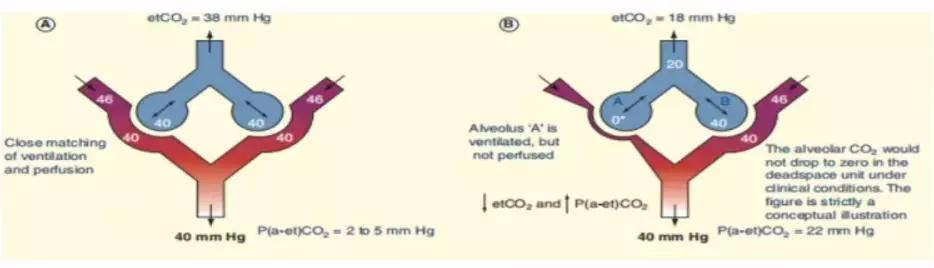 李娟教授：呼气末二氧化碳分压监测的临床应用