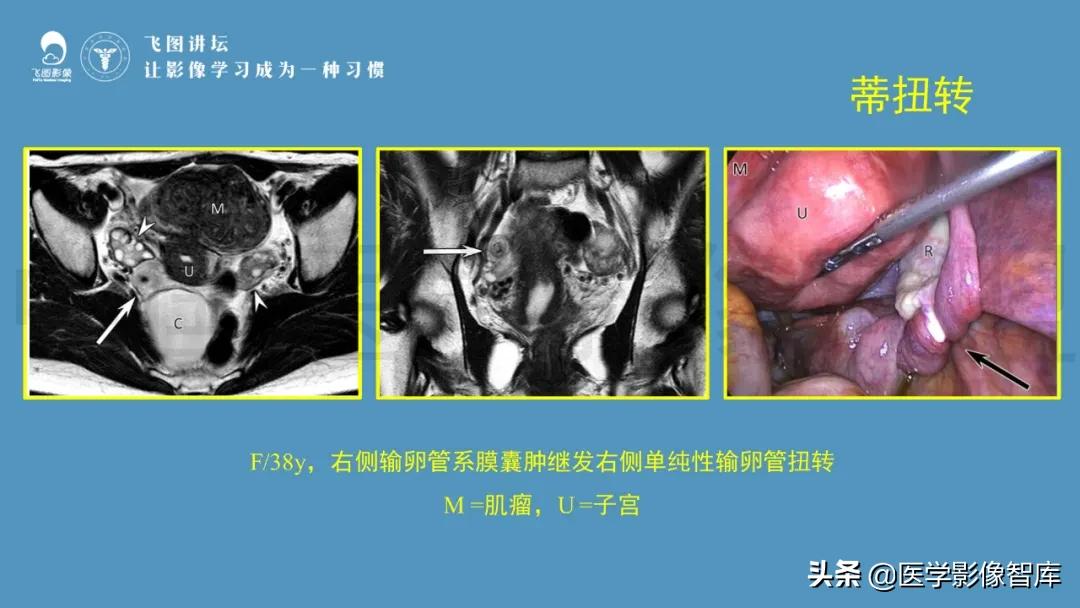 子宫解剖结构输卵管和卵巢位置,子宫附件ct影像学正常解剖表现