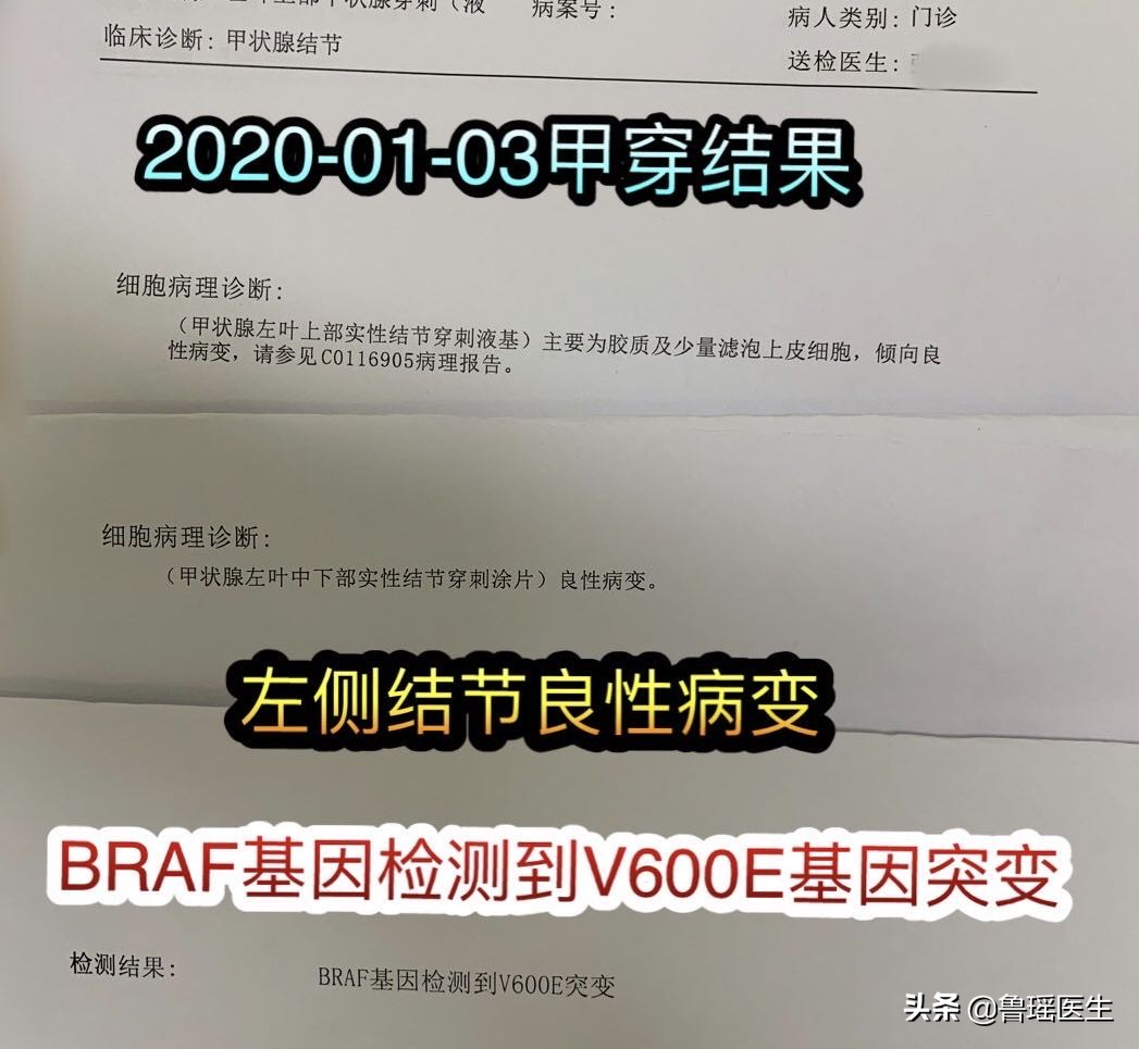 甲状腺穿刺v600e突变是什么意思,b超甲状腺结节误判率