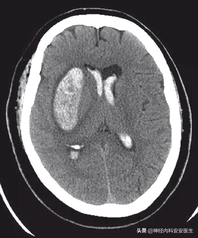 脑梗塞造成的感觉异常有哪些症状,脑梗塞发作是不是浑身无力