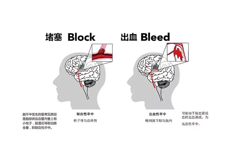 中老年人，中风7大危险因素，不可不知，夏季需做好六种警惕