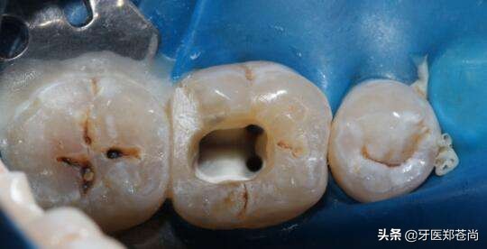 根管治疗后树脂填充还是戴牙冠好,根管治疗后的牙不疼用拔掉吗