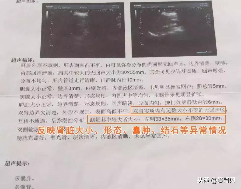 复查心里没底？简单易懂的肾内科检查解读，给每一位需要的肾友