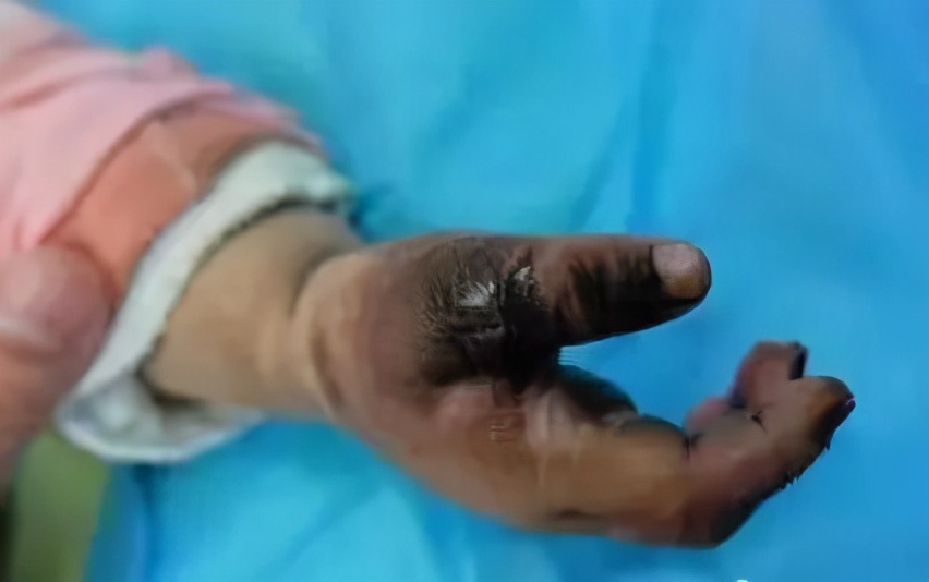 女童误吞降压药身亡,女童服降压药身亡