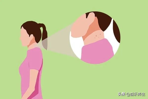50岁男人脖子上长小肉粒怎么回事,脖子两侧长小肉粒是什么原因