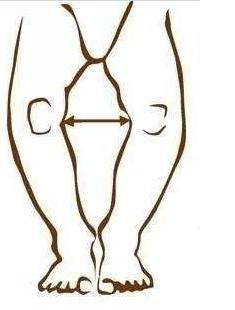 新生儿罗圈腿是什么原因,新生儿需要绑腿防止罗圈腿吗