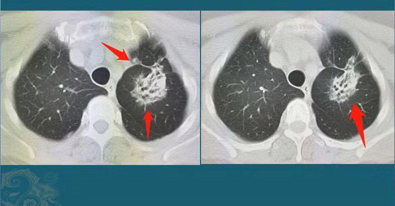 辟谣得了癌不治能活得更久,癌症能不能治医生说了大实话