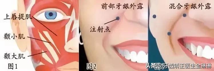 露龈笑对颜值有多大影响,颜值杀露龈笑